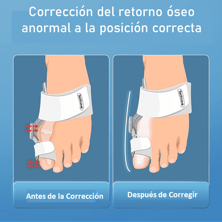 CORRECTOR DE JUANETES DE PIE GORDO CON FÉRULA ACTUALIZADO 🦶🦵 FootFlexor